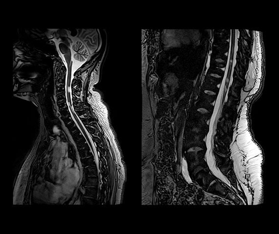 Spinal Cord