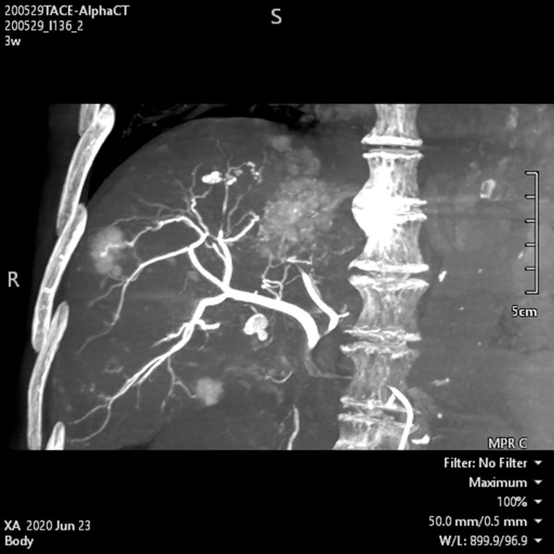 Alphenix Abdominal Alpha CT