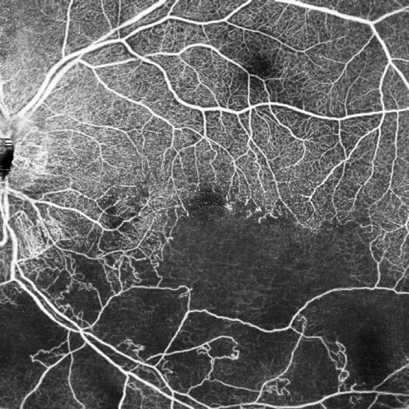 Branch retinal vein occlusion