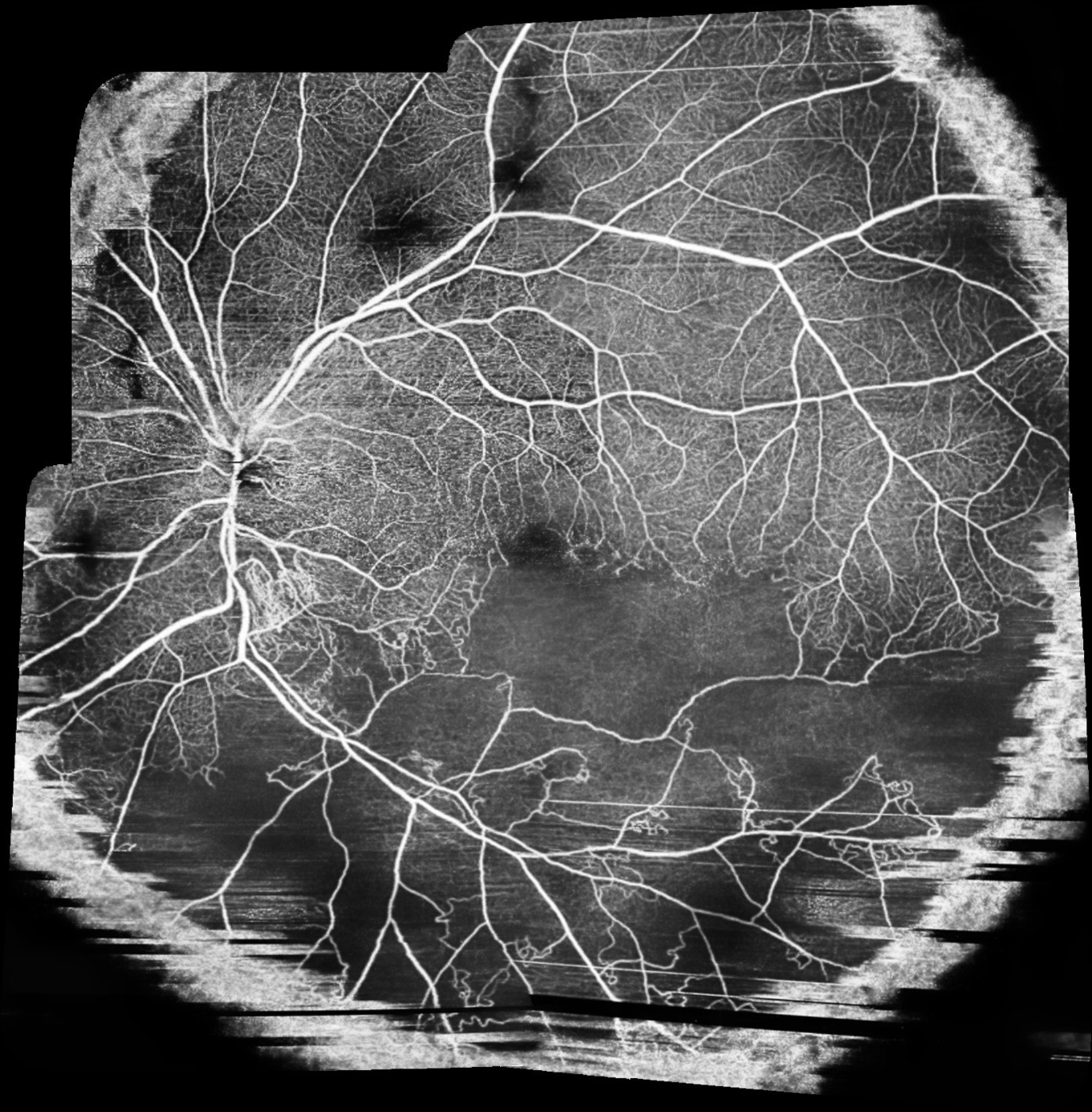 Branch retinal vein occlusion