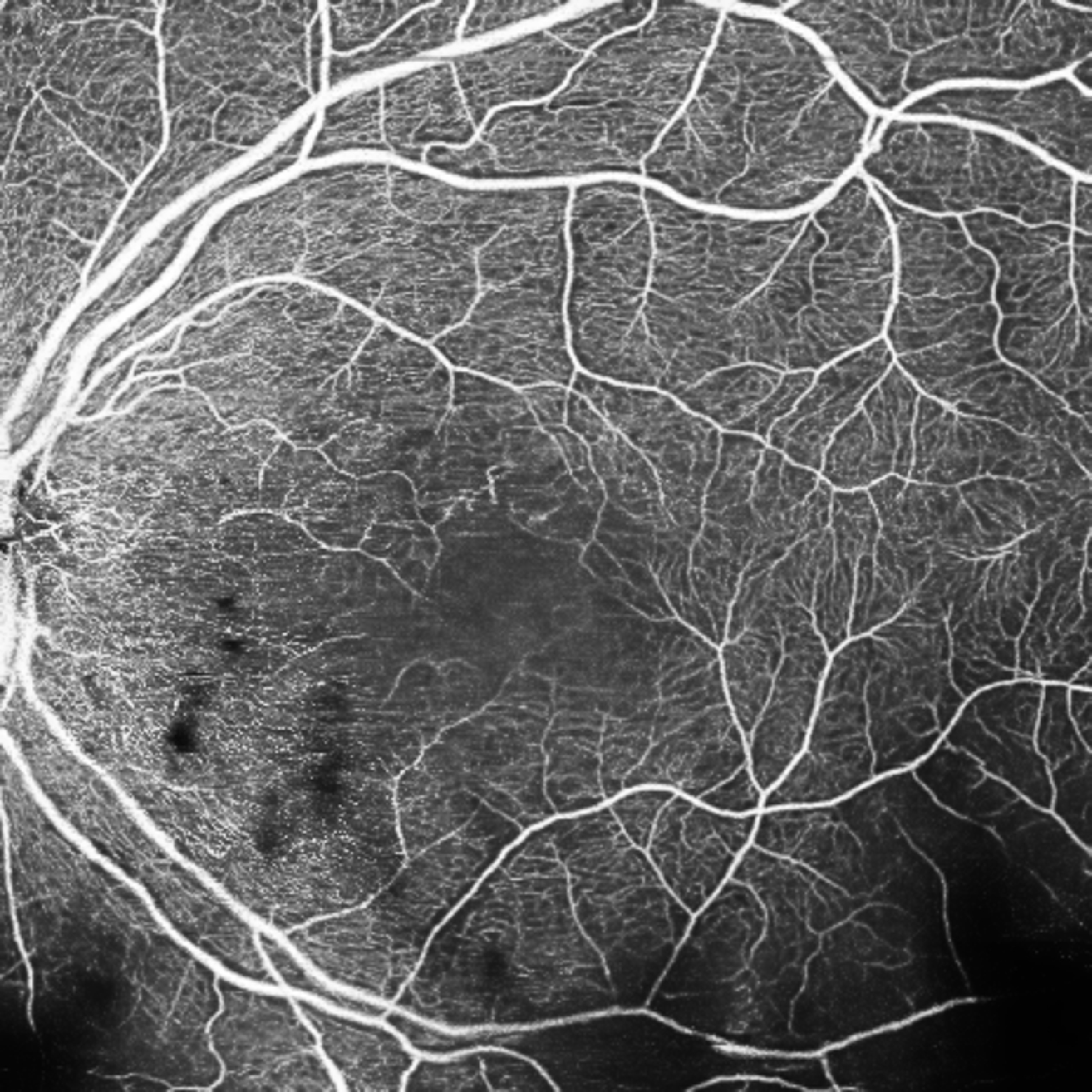 Behcet's disease