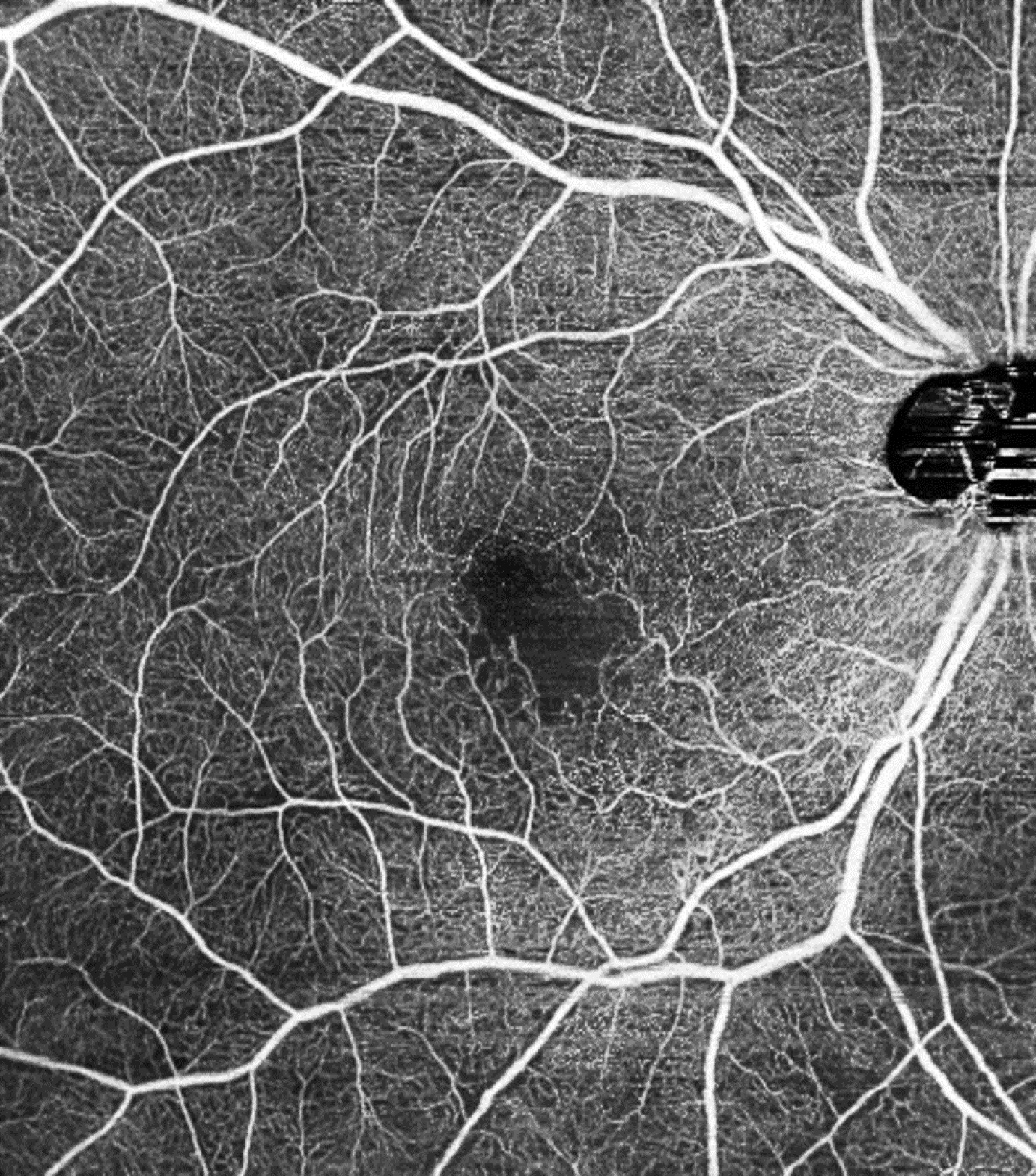 Ischaemic maculopathy