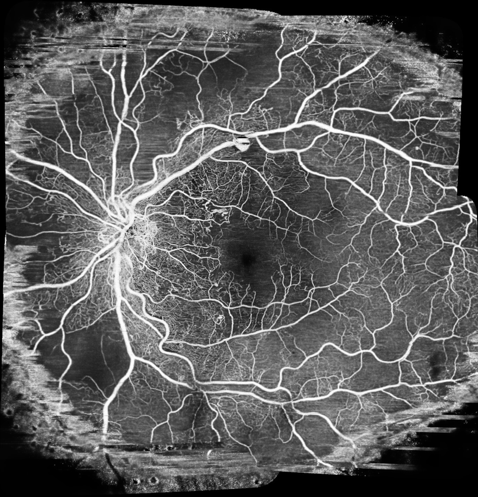 Proliferative diabetic retinopathy