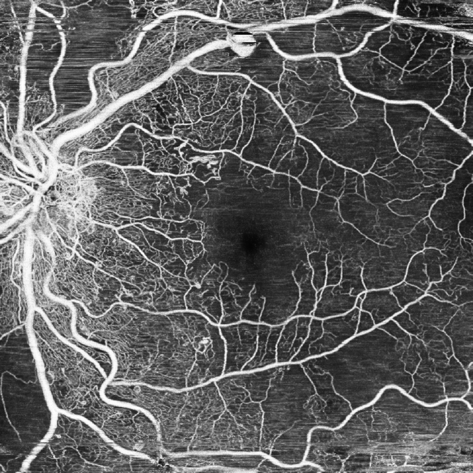 Proliferative diabetic retinopathy