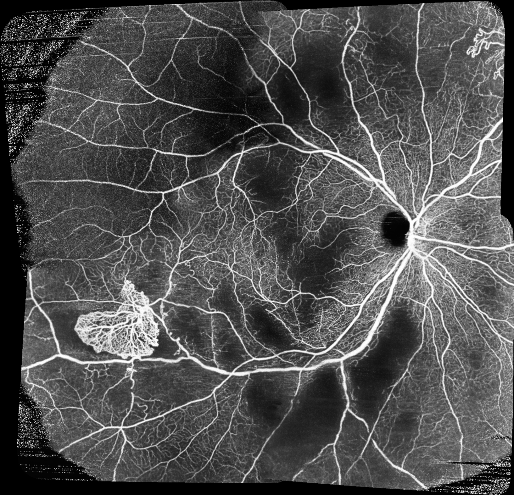 Severe systemic lupus erythematosus (SLE)