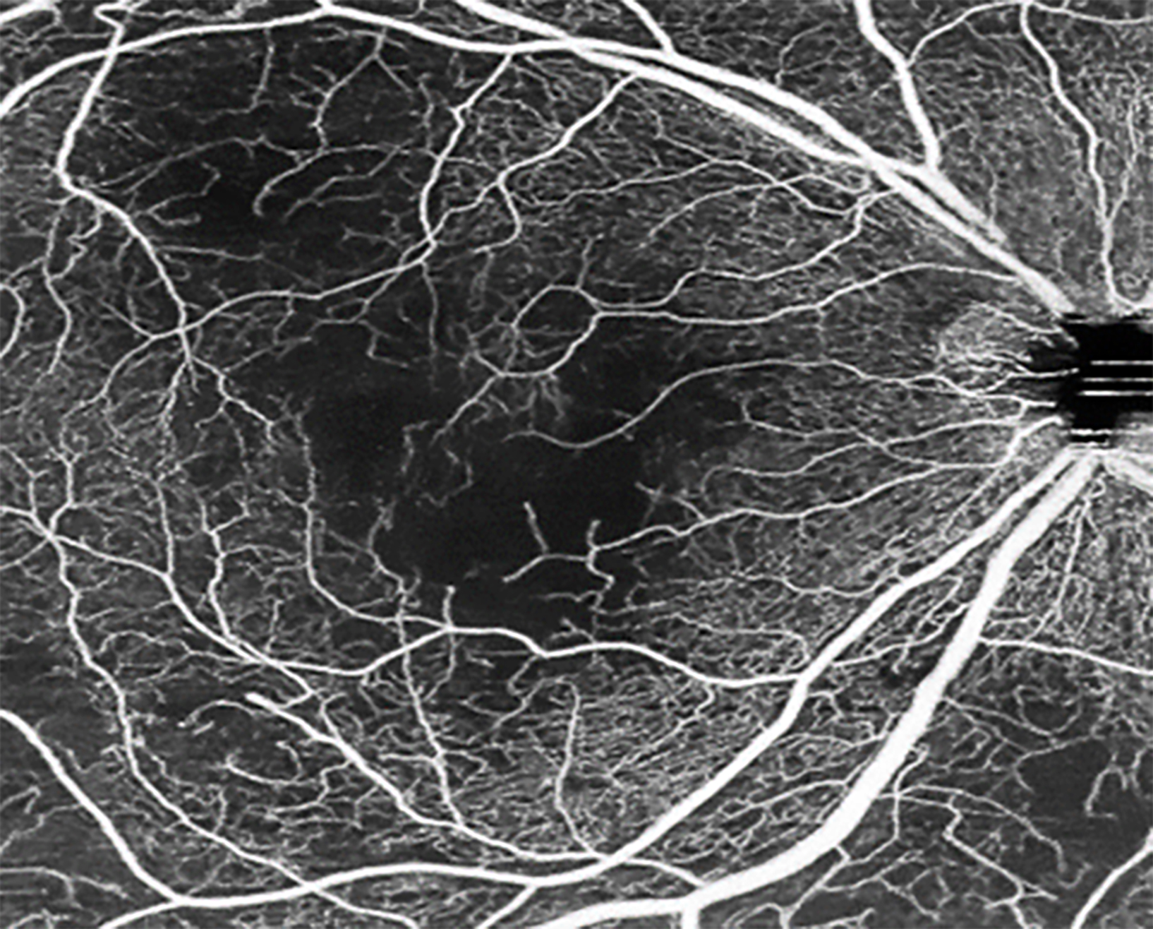 Severe systemic lupus erythematosus (SLE)