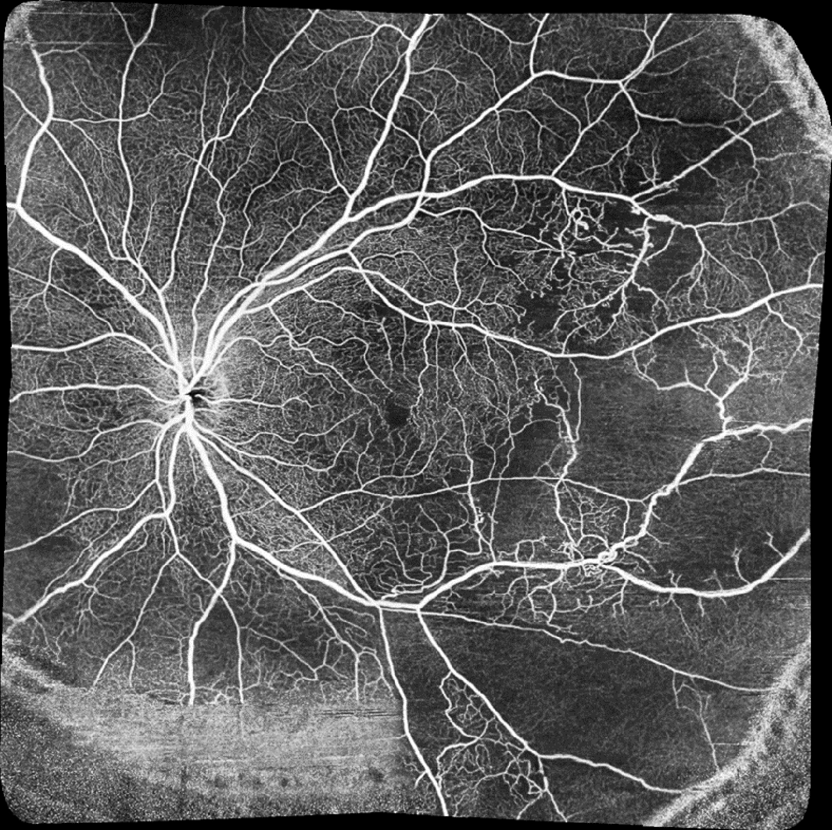 Severe systemic lupus erythematosus (SLE)
