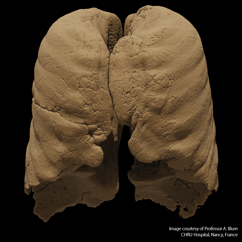 Lung